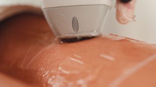 脱毛施術のイメージ
