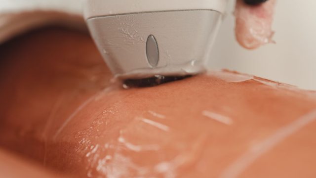 脱毛施術のイメージ