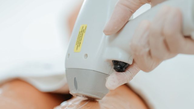 脱毛施術のイメージ
