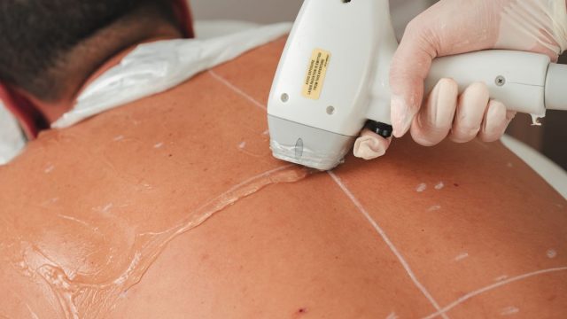 脱毛施術のイメージ